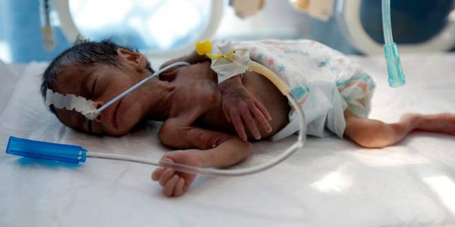 yemen-baby-malnourished
